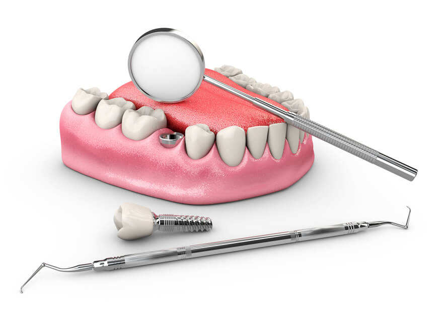 Implantes dentales Vibart Dental Clinic