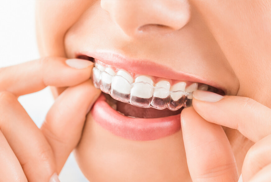 Ortodoncia invisible - Vibart Dental Clinic